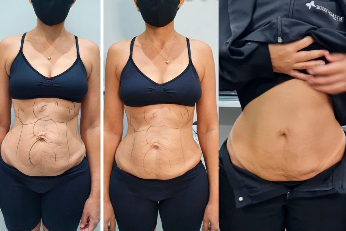 Abdômen antes, logo após e 3 meses depois do tratamento com Cryo RF Max do Unyque PRO