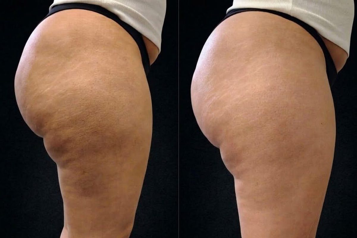 Antes e depois do Unyque PRO: glúteos e coxas de perfil